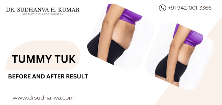 Everything You Need To Know About Tummy Tuck 1 Coming SoOn 2