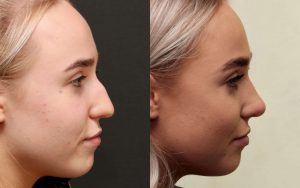 Choose the Right Cosmetic Surgeon for Rhinoplasty(Nose Job) 1 before and after nose lob 300x188 1