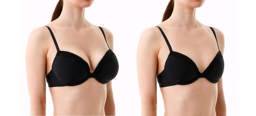 bust woman before after breast augmentation surgery woman bra with different sizes breast white background plastic surgery concept 168410 2683 1
