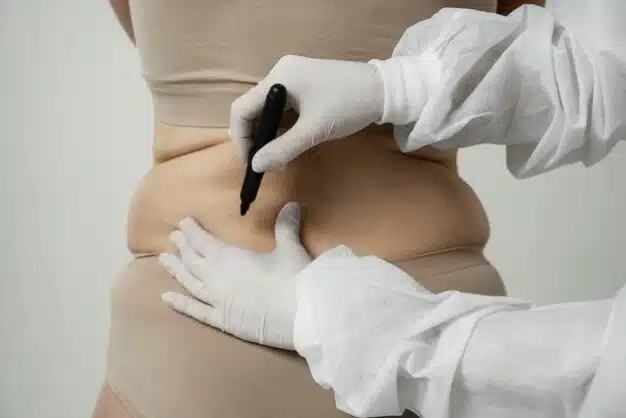 What Body Areas Can Be Treated by Liposuction? 4 Untitled design 2025 07 17T153648.721 1