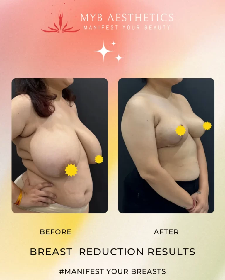 Breast Reduction Results Patient 2 Before and after image right angle profile 768x955 1
